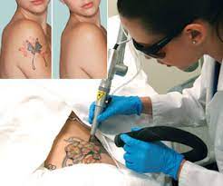 See the before & after photos, procedure videos, faq's, patient testimonials etc. Laser Tattoo Removal System India Cost Laser Tattoo Removal System Laser Tattoo Removal Mumbai Delhi India