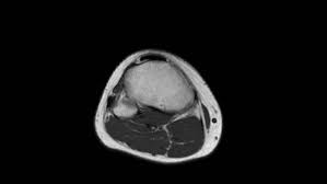 The knee joint is a modified hinge joint between the femur, tibia, and patella. Mri Of Knee Axial Of Stock Footage Video 100 Royalty Free 1021316686 Shutterstock