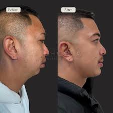 Today, we're diving into an interesting facial rejuvenation surgery with my  patient who is a Nurse Practitioner. For her, I planned a deep plane  facelift, deep necklift, Buccal fat removal, facial fat