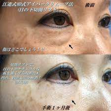 くま取り 目の下切開リフト 江連式 美容外科医に見られてもばれにくい傷と仕上がり 美容整形 目の下 切開