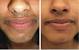 Laser Hair Removal Shedding