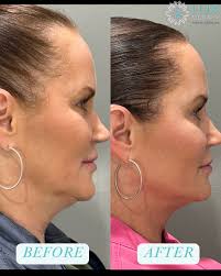 Understanding the difference between PDRN and PDGF is key to choosing the  right regenerative treatment for your skin.☺️ At our spa, we use trusted  brands like Rejuran and Ariessence to target specific