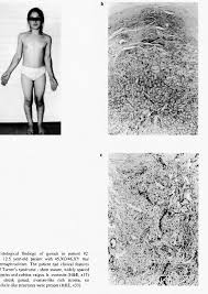 Image result for True Hermaphroditism