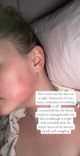 Face Psoriasis Night Routine