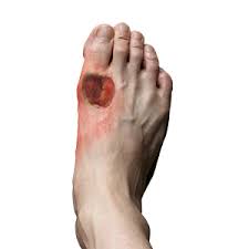 Image result for diabetic toes