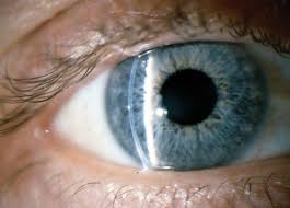 Image result for Eye Foreign Body