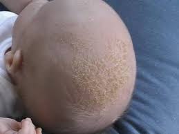 Hair loss is more common than you think and can happen to anyone. Newborn Baby Dry Skin Scalp Newborn Baby