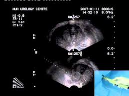 Prostate cancer is one of the most common types of cancer diagnosed in men. Transrectal Ultrasound Prostate Biopsy Periprostatic Nerve Block Video Medtube Net