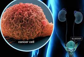 Urinary obstruction and bleeding are common signs. Bladder Cancer Center Symptoms Causes Tests Diagnosis Staging And Treatments