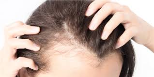 The conversion of testosterone to dht has been strongly correlated with hair miniaturization, a. Creatine Hair Loss Causes Side Effects And Treatments