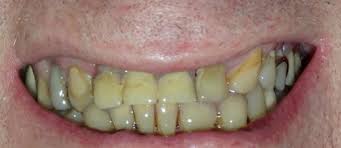 When you get yellow or brown stained teeth from smoking, the discolouration can be quite noticeable and hard to get rid of. How Can I Get Rid Of Yellow Teeth Old Town Smiles