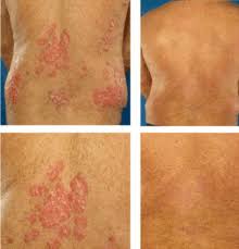 Depois que finalmente fui a consulta Psoriase Wikipedia A Enciclopedia Livre