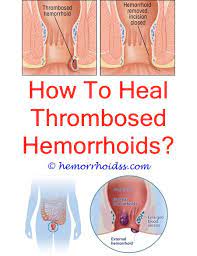 How Do You Get Rid Of Hemorrhoids Fast Bleeding Hemorrhoids Hemorrhoid Remedies Cure For Hemorrhoids