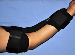Outcomes Of Rigid Night Splinting And Activity Modification In The Treatment Of Cubital Tunnel Syndrome Journal Of Hand Surgery