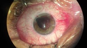La pérdida de funcionalidad de las cristalinas provoca la formación y la aceleración de la formación de cataratas en los ojos. Cirugia Completa De Catarata Por Facoemulsifcacion Y Colocacion De Lente Intraocular Youtube