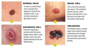 skin cancer dermatologist in bethesda md