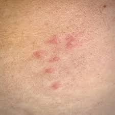 Image result for flea bites