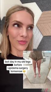Lipidema and Liposuction Transformation Before and After