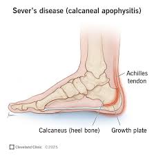 Image result for Calcaneus
