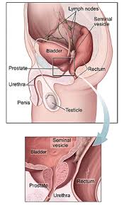 The prostate is the gland in a man's pelvis that wraps around the urethra and. Prostate Cancer Man Up Australia