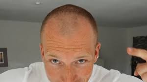Frisuren männer lichtes haar haare sind einer dieser wichtigsten teile eines menschlichen körpers, dieser in gewissem metrik die persönlichkeit des einzelnen widerspiegelt. Haare Weg Wie Damit Umgehen Schmale Glatze Youtube