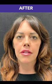 💋 LIP GOALS 💋 Heather Potter-Emery with The Joey and Heather Morning Show  & 98-9 KISS FM is getting her {first ever} lip filler! Kasey Swayden, our  talented PA, will explain the technique she’s using ...