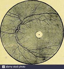 Le fond d'œil est souvent prescrit par les médecins traitants. Plecis Des Maladies Des Enfants Ent Plusieurs Enfants Dune Meme Famille Des Lage Dequatre A Six Mois Elle Sannonce Par Une Apathie Progressive Len Fant Cesse De Faire Des Mouvements Appropries A