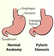 The narrowing may not cause any symptoms. Department Of Surgery Pyloric Stenosis