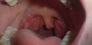 Over time, there will be bleeding from the nose as well as mouth. Patients With Mouth And Oesophageal Cancers Take Longer To Seek Help From Gp University Of Cambridge
