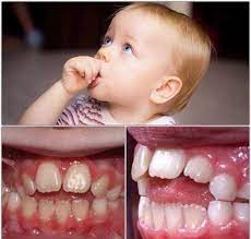 And that's not including the cost of a speech therapist if the situation is left. Are Thumb Sucking And Pacifier Habits Badly Affect My Child S Teeth Chisel Dental Clinic Blog