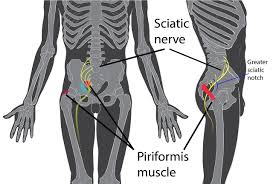 Tens Unit Placement Chart For Sciatica Www