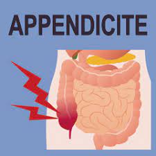 Non traitée, elle peut être mortelle, principalement par péritonite et sepsis ; Appendicite Cos E E Come Riconoscerla Issalute
