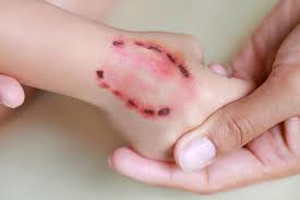 The initial symptoms of rabies are fever and often pain or an unusual or unexplained tingling, pricking or burning sensation (paraesthesia) at the wound site. What Are The First Symptoms Of Rabies In Humans Can You Be Vaccinated How Is It Caught And What Is The Treatment