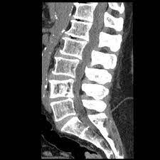Picture frame moulding for wood picture frames, wood moldings, picture frame wood, aluminium picture frames, wood veneer and bare wood mouldings. Vertebral Paget Disease With Picture Frame Appearance Image Radiopaedia Org