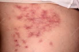 Image result for Panniculitis