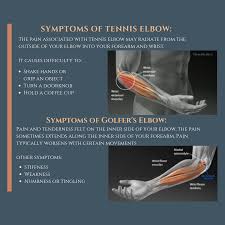 Medial epicondylitis (golfer's elbow) is a condition in which the bony bump at the inside of the elbow is painful and tender. Casecon Tennis Elbow Lateral Epicondylitis Golfer S Elbow Medial Epicondylitis Tennis Elbow Golfers Elbow Tennis Elbow Symptoms