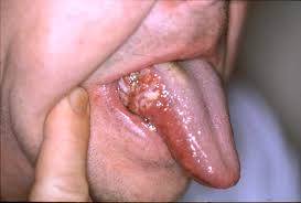 Image result for white cancer on tongue)