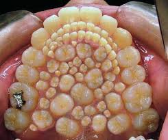 supernumerary teeth supernumerary teeth hyperdontia