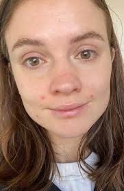 Laura Henshaw: Makeup-free selfie highlights reality of changing skin