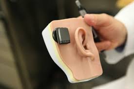 Image result for Cochlear Implant