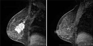 Breast mri is sometimes used in women who already have been diagnosed with breast cancer, to help measure the size of the cancer, look for other tumors in the breast, and to check for tumors in the opposite breast. Mri In Diagnosis Of Pathological Complete Response In Breast Cancer Patients After Neoadjuvant Chemotherapy Sciencedirect