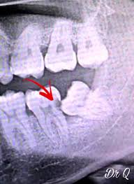 Bagi orang dewasa, jumlah gigi kekal berjumlah 32 batang gigi termasuklah gigi bongsu. Dr Q On Twitter Yang Ada Gigi Bongsu Tumbuh Senget Tu Dah Buat Xray Selalu Kes Gigi Bongsu Ni Gigi Sebelah Yang Jadi Mangsa Cuba Lihat Anak Panah Tu Nampak Tak Hitam