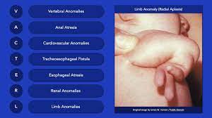 Vacterl Association Clinical Features Youtube