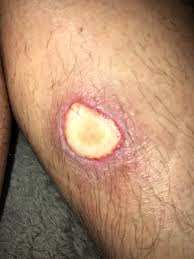Image result for wolf spider bite skin