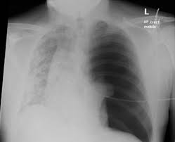 A pneumothorax occurs when air leaks into the space between your lung and chest wall. Tension Pneumothorax In A Patient With Covid 19 Bmj Case Reports