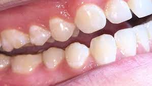 Should I Be Worried About My Worn Teeth
