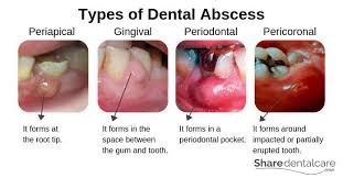 I had a distant relative that had an abscessed tooth. Types Of Dental Abscess There Dmd Care Dental Clinic Facebook
