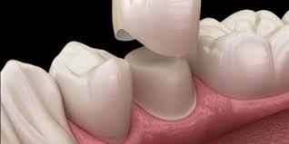 If your bite does not feel comfortable after a few days or you feel that you're having dental crown procedure pain, reach out to your oral care provider so that they can examine it and make any adjustments. What Are The Common Causes Of Bite Pain On A Crowned Tooth