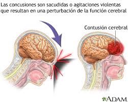 El estado de conmoción interna es un recurso que tengo como jefe de estado si se presentan hechos de golpismo (.) no lo dudaré para decretarlo si fuera necesario para decretarlo cuando haga. Conmocion Cerebral Medlineplus Enciclopedia Medica