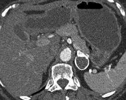 Whether an adrenal mass is identified serendipitously or is being imaged for further characterization, there are several ct findings that contribute to the diagnosis, such as lesion size, precontrast guishing benign from malignant adrenal masses: Adrenal Mass Imaging With Multidetector Ct Pathologic Conditions Pearls And Pitfalls Radiographics